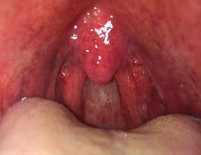 吃白瓜喉咙肿,揭秘饮食安全与应急处理