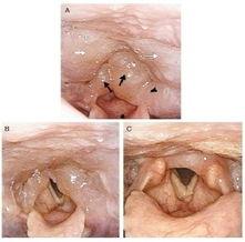 吃白瓜喉咙肿,揭秘饮食安全与应急处理  第3张